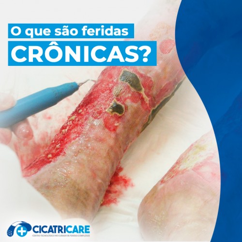 O que são feridas crônicas?