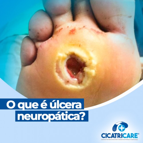 O que é úlcera neuropática?