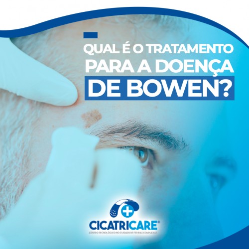 Qual é o tratamento para a doença de Bowen?