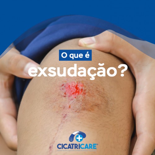 O que é exsudaçăo?