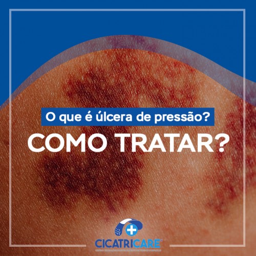 O que úlcera de pressão? Como tratar?